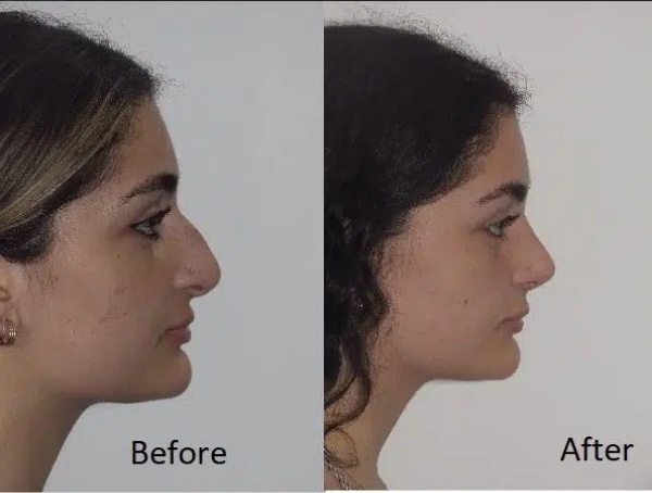Dorsal Hump Reduction Choosing a Nose Surgeon or Rhinoplasty Surgeon in Sydney - 1
