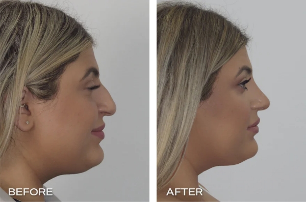 Best Rhinoplasty Surgeon Sydney - best nose surgeon sydney