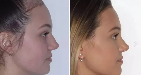 turned-up nose types sydney - Dr Jeremy Hunt Leading face surgeon