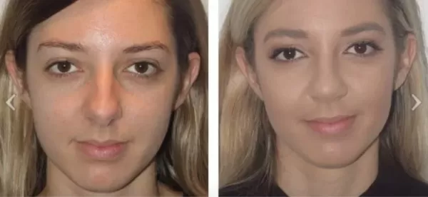 Different Nose Shapes - Dr Jeremy Hunt Leading face surgeon