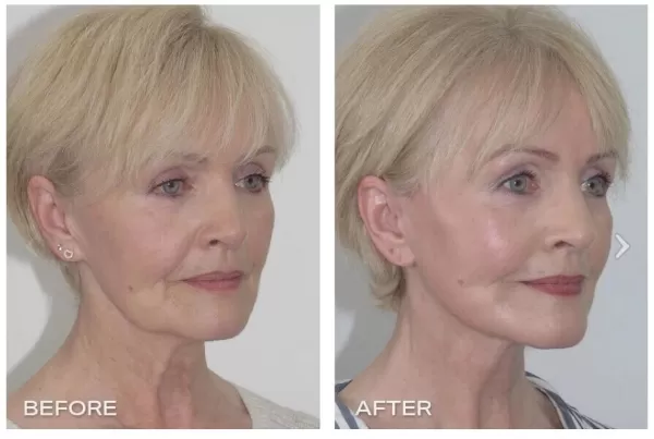 What is neck lift or lower facelift - Dr Jeremy Hunt Leading Plastic Surgeon Sydney NSW