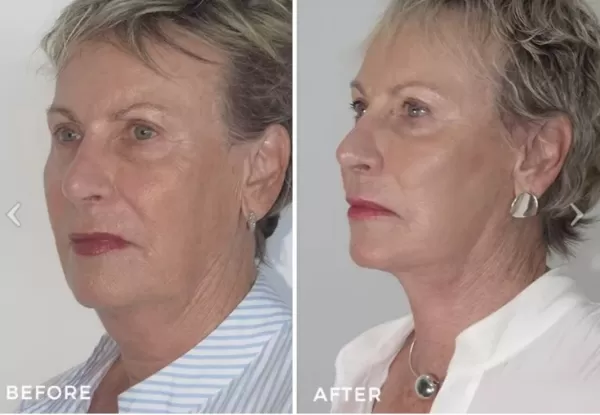 Facelift 2 e1646033439655 Facial Asymmetry Problems - What are Your Options for a Lopsided Face? - 1