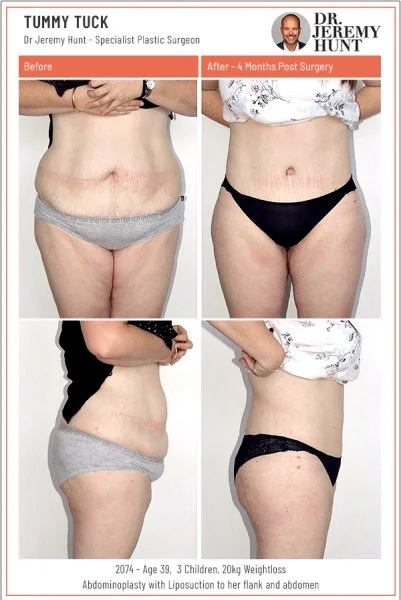 2074 tummy tuck sydney dr jeremy hunt