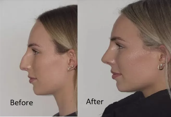 High Nasal Dorsum Nasal Dorsum Surgery – Rhinoplasty to Correct the Nose Bridge - 1