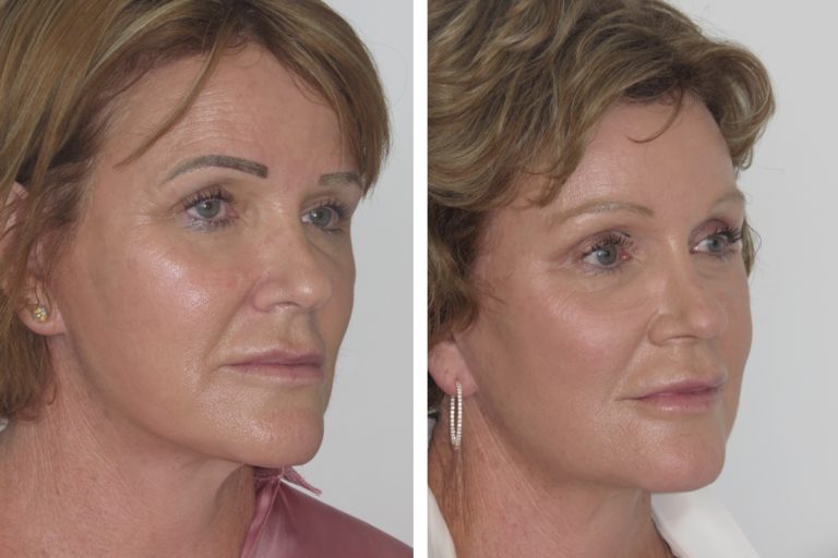 Brow lift surgery, before and after, angle view, Dr Jeremy Hunt, 2170 @2x