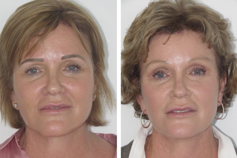 Brow lift surgery, before and after, front view, Dr Jeremy Hunt, 2170 @2x
