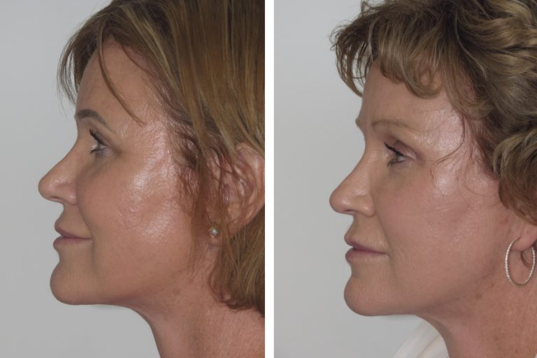Brow lift surgery, before and after, side view, Dr Jeremy Hunt, 2170 @2x