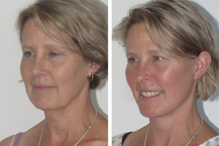 Deep plane facelift before and after, female patient, angle view, Dr Hunt Sydney, 2172 @2x