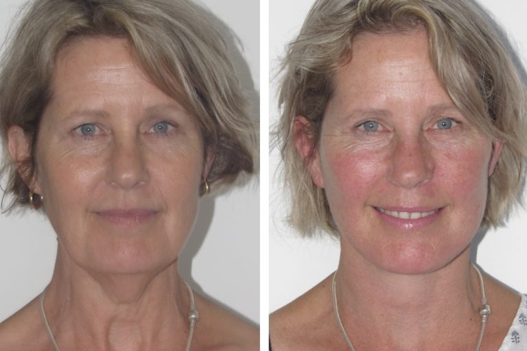 Deep plane facelift before and after, female patient, front view, Dr Hunt Sydney, 2172 @2x