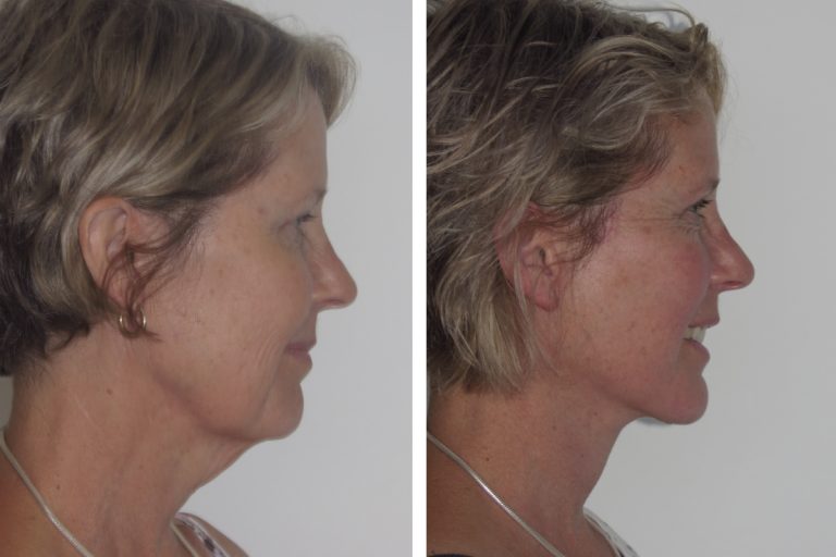 Deep plane facelift before and after, female patient, side view, Dr Hunt Sydney, 2172 @2x