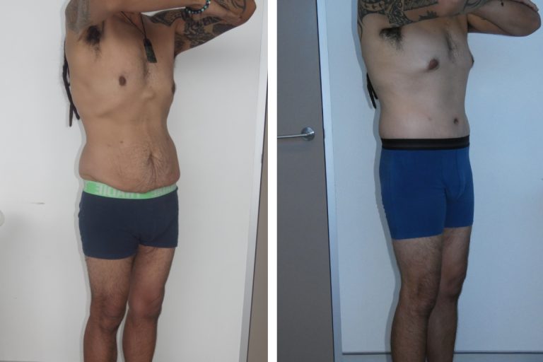 Male patient before and after lower body lift and buttocks augmentation surgery, Dr Jeremy Hunt Sydney, 3185 @2x, angle view