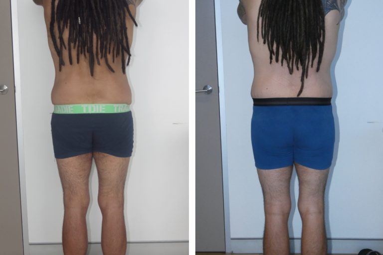 Male patient before and after lower body lift and buttocks augmentation surgery, Dr Jeremy Hunt Sydney, 3185 @2x, back view