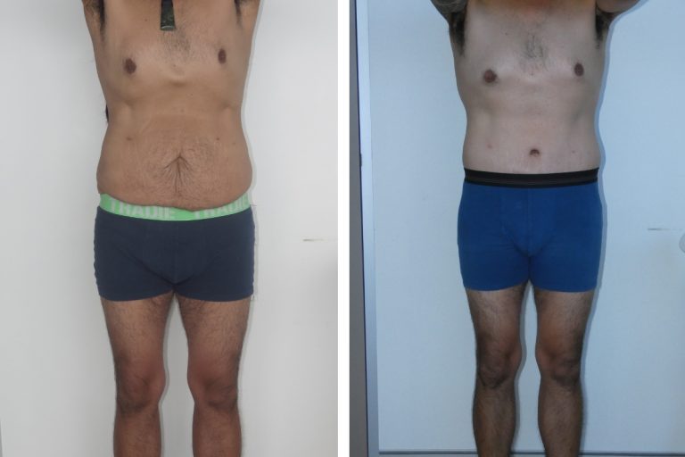 Male patient before and after lower body lift and buttocks augmentation surgery, Dr Jeremy Hunt Sydney, 3185 @2x, front view
