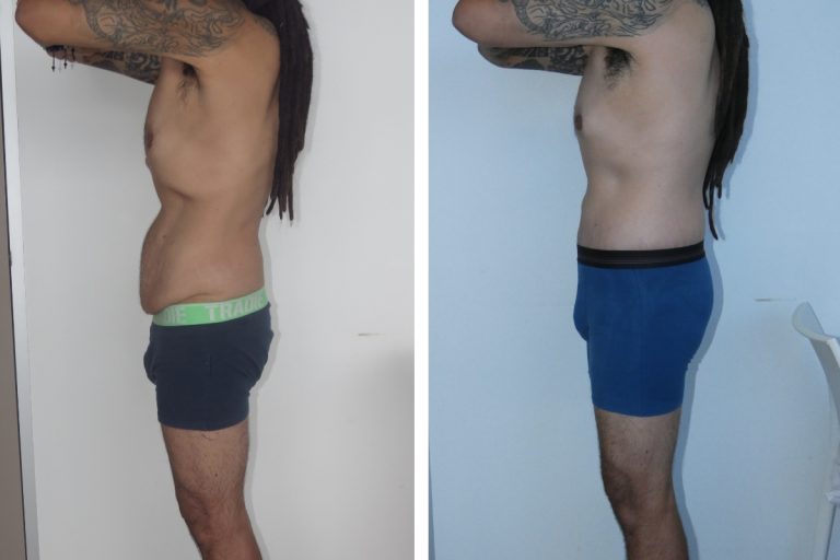 Male patient before and after lower body lift and buttocks augmentation surgery, Dr Jeremy Hunt Sydney, 3185 @2x, side view