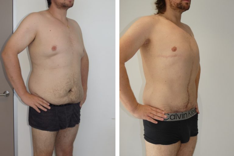 Male patient before and after upper body lift surgery (arm lift and gynaecomastia surgery), Dr Jeremy Hunt Plastic Surgery Sydney, angle view, 4052 @2x