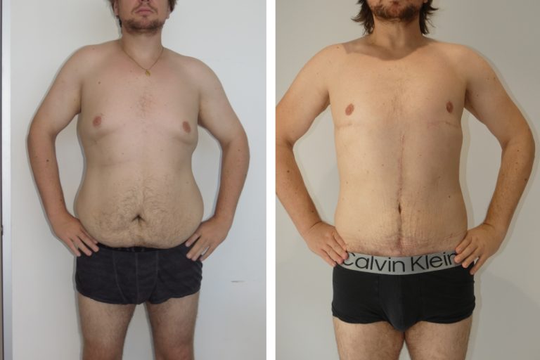 Male patient before and after upper body lift surgery (arm lift and gynaecomastia surgery), Dr Jeremy Hunt Plastic Surgery Sydney, front view, 4052 @2x