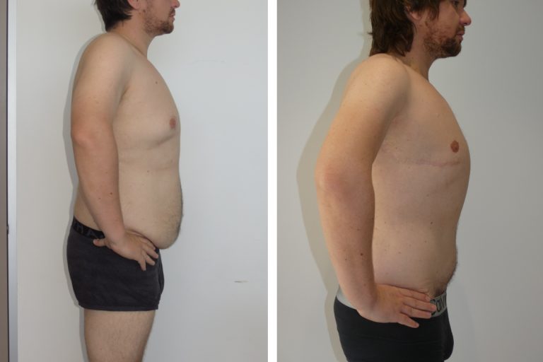 Male patient before and after upper body lift surgery (arm lift and gynaecomastia surgery), Dr Jeremy Hunt Plastic Surgery Sydney, side view, 4052 @2x