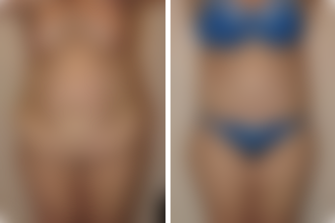 abdominoplasty-results-img
