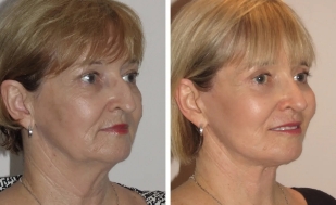 facelift-balpimg4